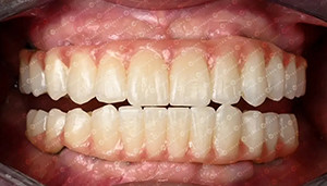 τελευταία εταιρεία περί Υποθέσεις πελατών. 4D μπλοκ ζιρκονίας.