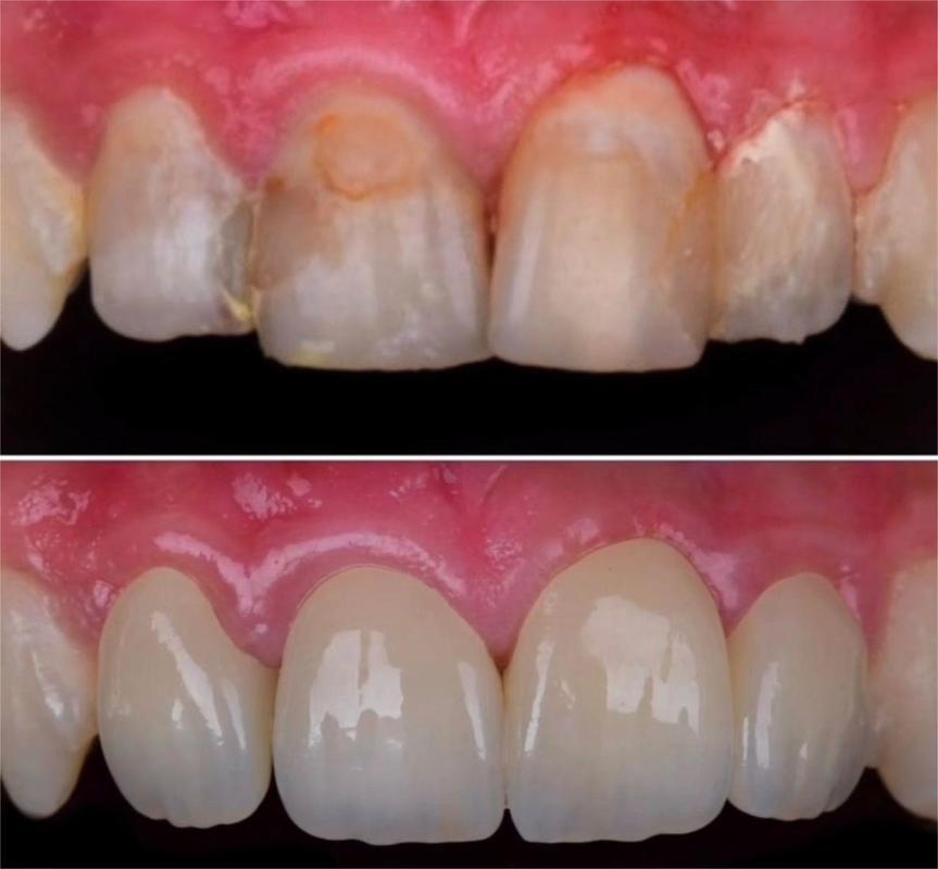 Yucera 4D Pro Zirconia Blocks the Choice for High-Quality Dental Restorations