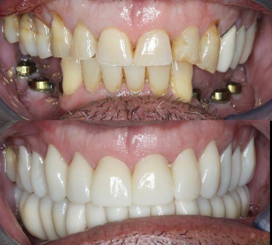 Yucera 4D Pro Dental Ceramic Blocks Quality and Precision