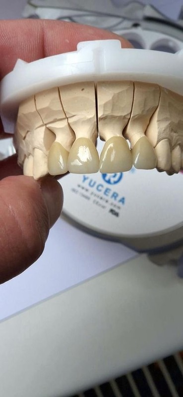 Yucera ST color 3D Multilayer Zirconia Block - Σχεδιασμένο με ακρίβεια για CAD/CAM Οδοντιατρική